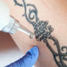 Laser Tattoo Removal