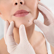Unwanted Moles and Lesions